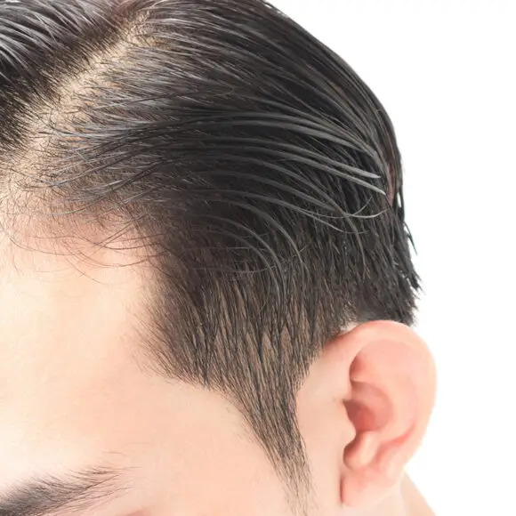 Hair Loss